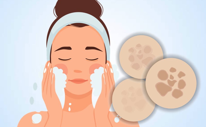 Mistakes in skin care make melasma worse. Graphics: Thien Nhan