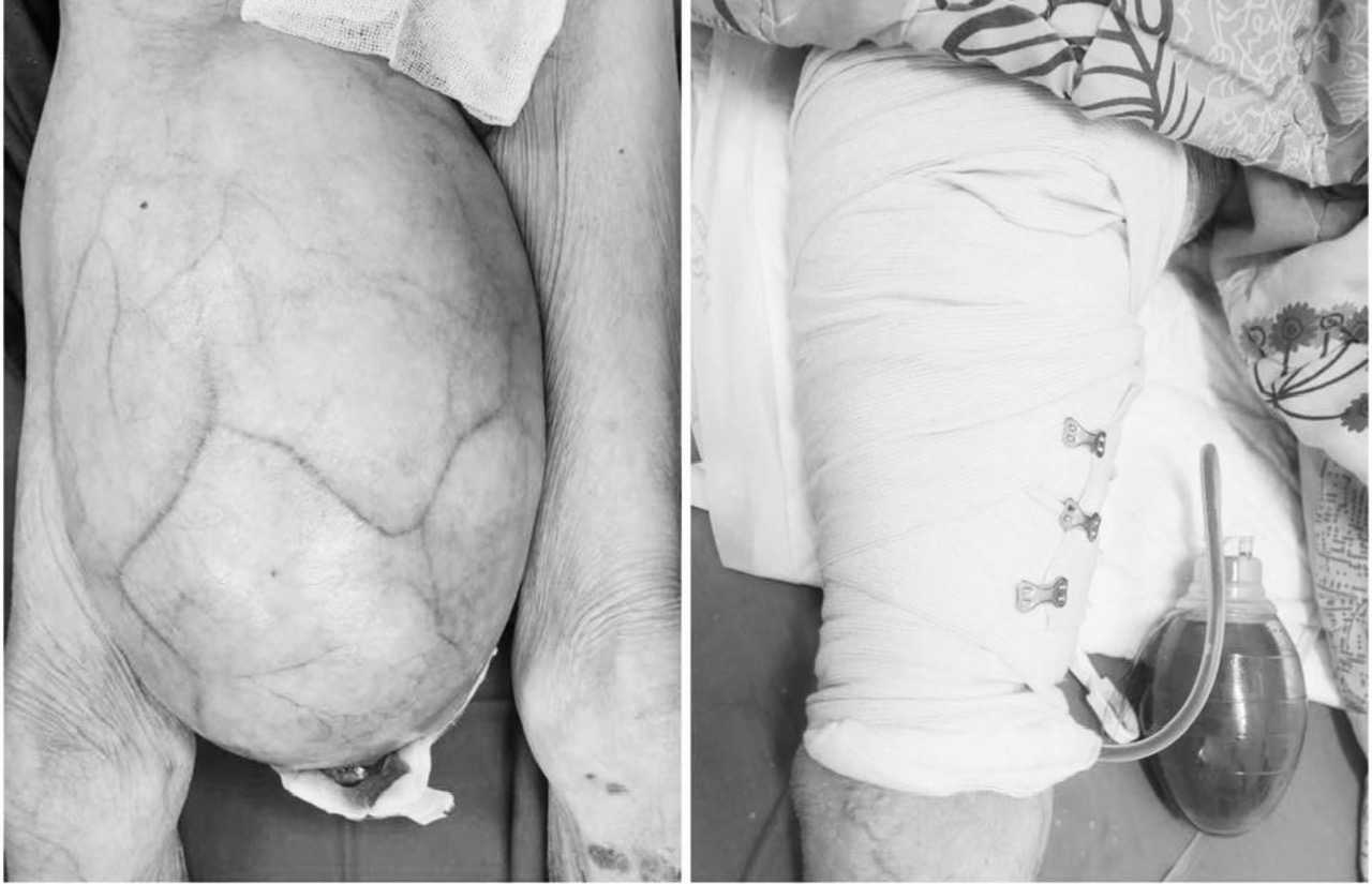 Khối u trước và sau phẫu thuật. Ảnh: BVCC