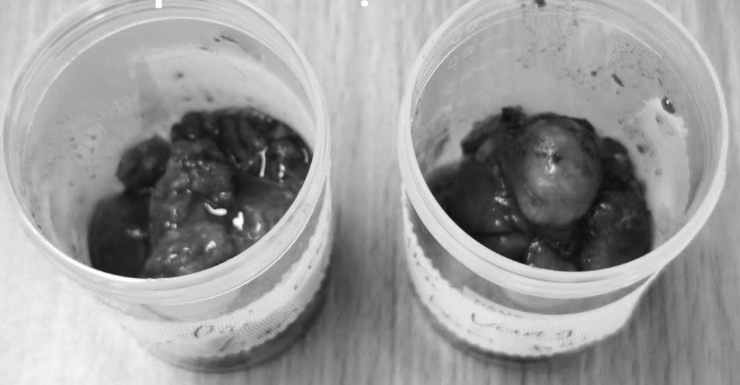 Khối u lấy ra sau phẫu thuật cho người bệnh. Ảnh: Thanh Đặng