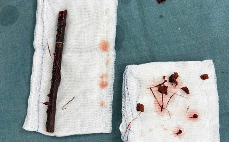 The 16cm long foreign object branch in the girl's belly for 4 months was successfully removed by the surgeon. Photo: BVCC