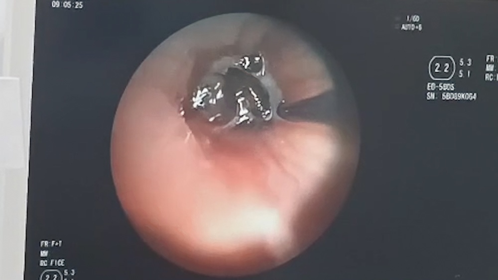 Les graines de sapot 17x8 mm ont ete oubliees pendant 10 ans dans les bronches