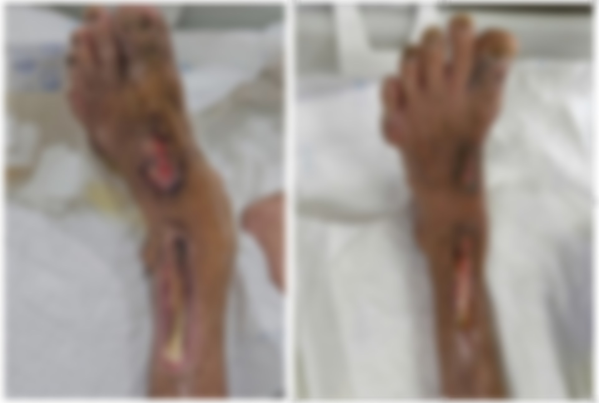 The patient's legs had complications from acne. Photo: BVCC