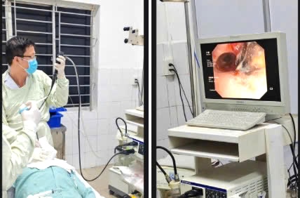 The team of the Department of Endoscopy at Thong Nhat General Hospital successfully removed a piece of the snail shell from the patient's bronchi. Photo: Provided by the hospital