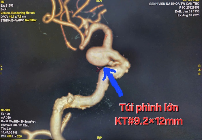 45 minutes to save the life of a 90-year-old woman with a large brain aneurysm