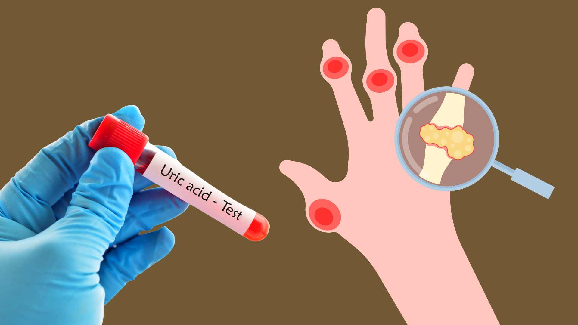 Signs of high uric acid. Graphic photo: Huong Giang