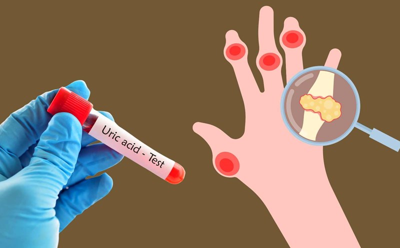 Signs of high uric acid. Graphic photo: Huong Giang