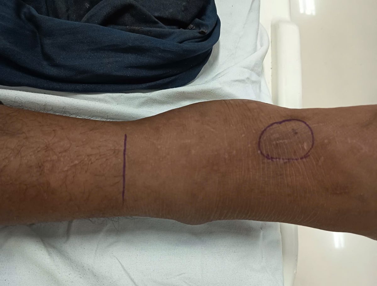 snake bites. Photo: Provided by the hospital