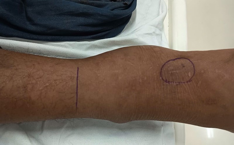 snake bites. Photo: Provided by the hospital
