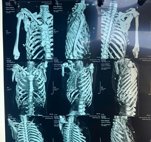 CT scan of the patient's serious injuries after the accident. Photo: Thanh Tuan