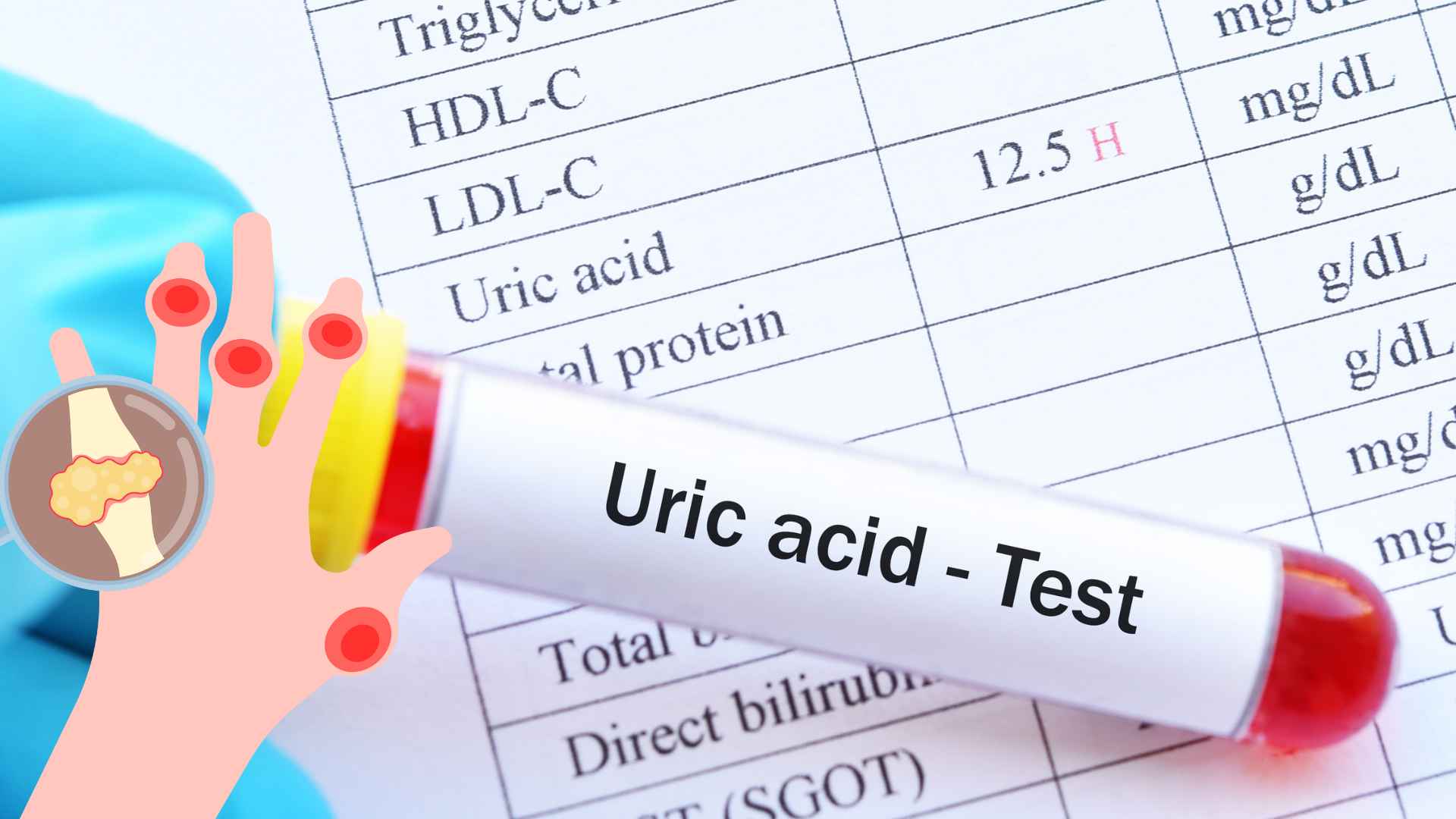 To control uric acid, in addition to following doctors' treatment, patients need to have a healthy lifestyle. Graphic photo: Huong Son