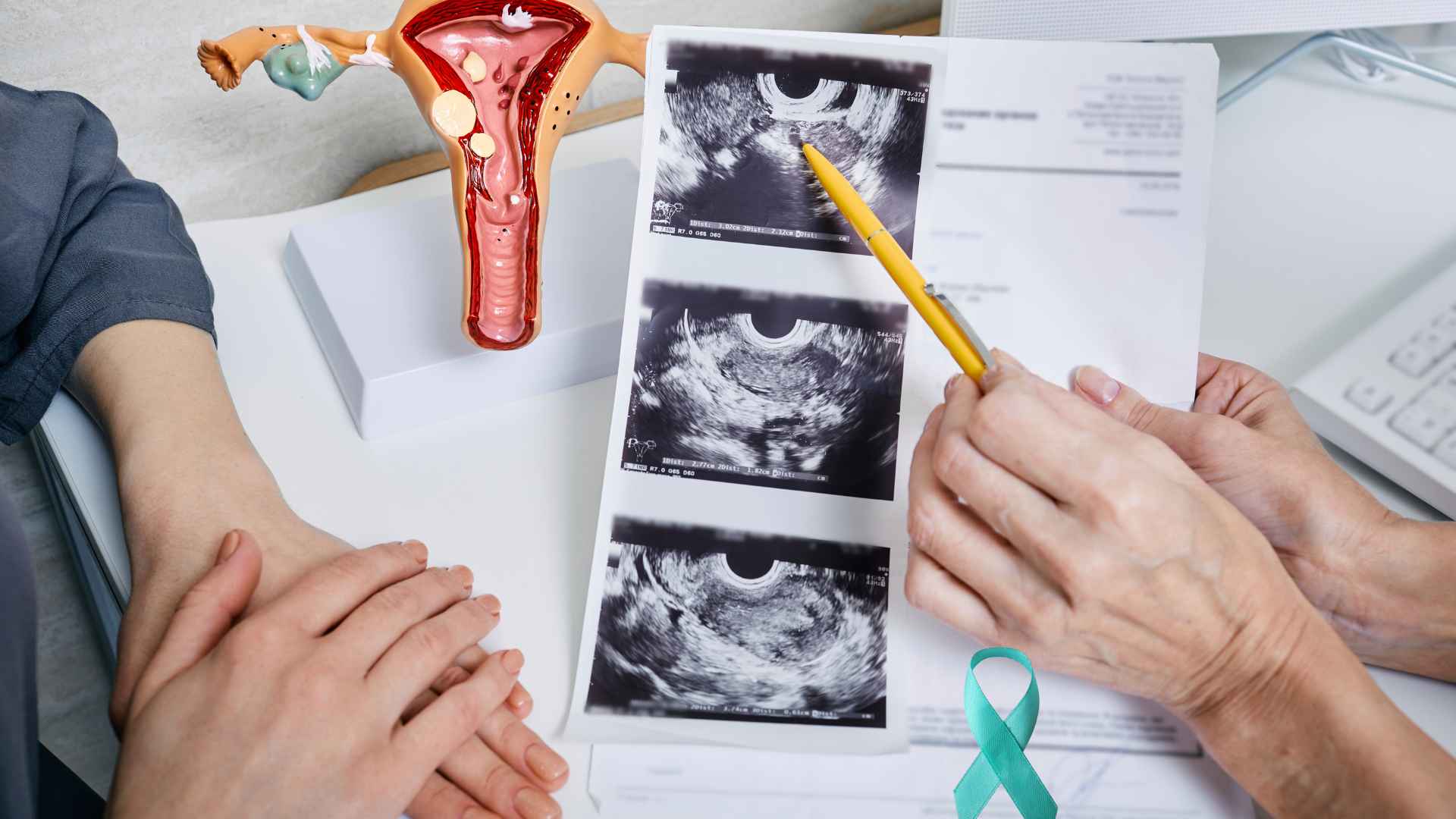 Polycystic ovary syndrome is common in women of reproductive age. Graphic photo: Huong Son