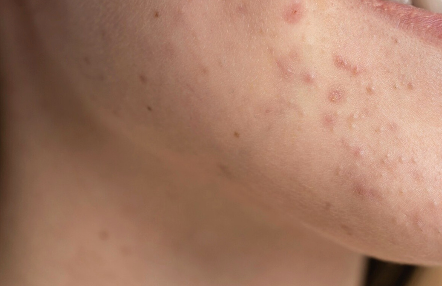 Acne caused by polycystic ovary syndrome is not only a cosmetic problem but also reflects endocrine disorders. Photo: Thuy Duong