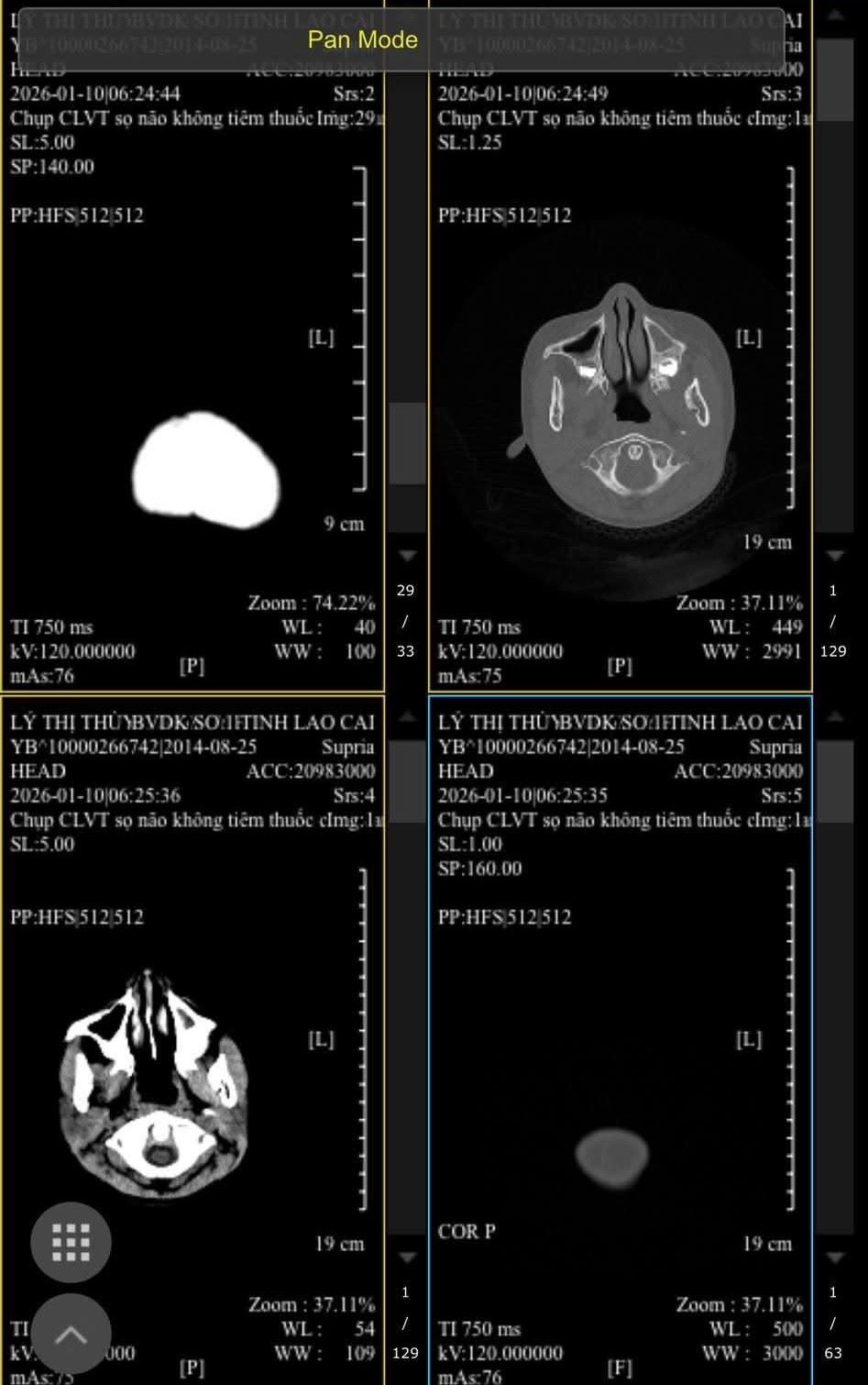 Chau C dang duoc dieu tri tai Benh vien Da khoa so 1 Lao Cai. Anh: Gia dinh cung cap.