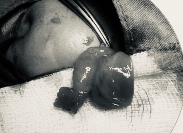 Ovaries and fallopian tubes were released promptly during surgery. Photo: BVCC