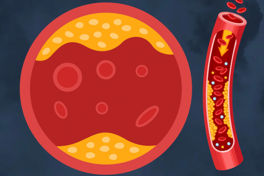 Nhieu nguoi khong mac benh van co the bi tac nghen dong mach do mang bam tich tu am tham trong nhieu nam. Do hoa: Thien Nhan