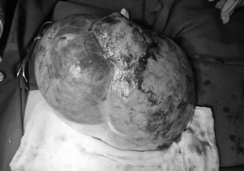 Large displaced testicular tumor removed from a cancerous abdominal cavity. Photo: BVCC