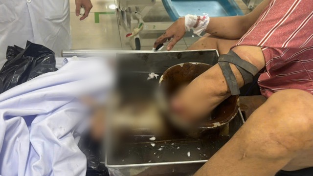 Patient's left hand was wrapped inside by a meat grinder. Photo: BVCC