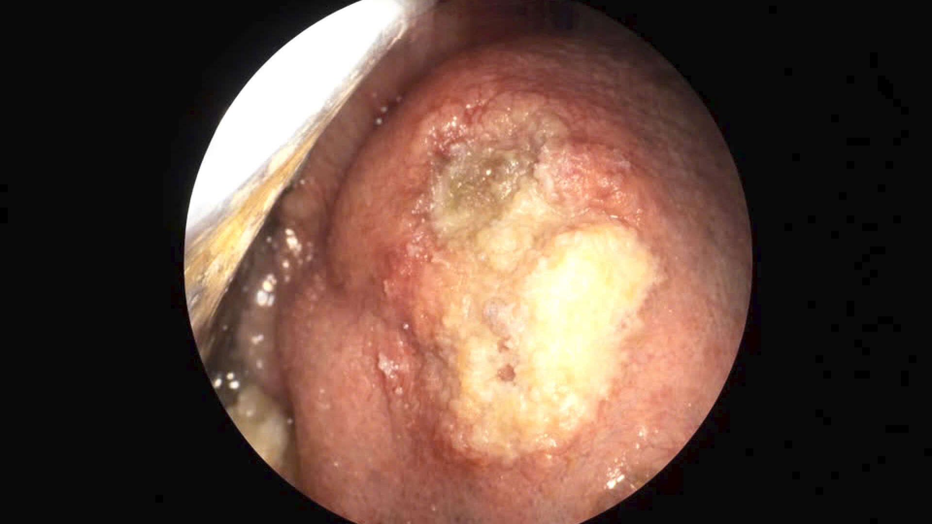 Vet loet luoi cua benh nhan nam 58 tuoi, tru tai Hai Phong, duoc bac si chan doan co nhieu dau hieu bat thuong. Anh: Hoang Khoi