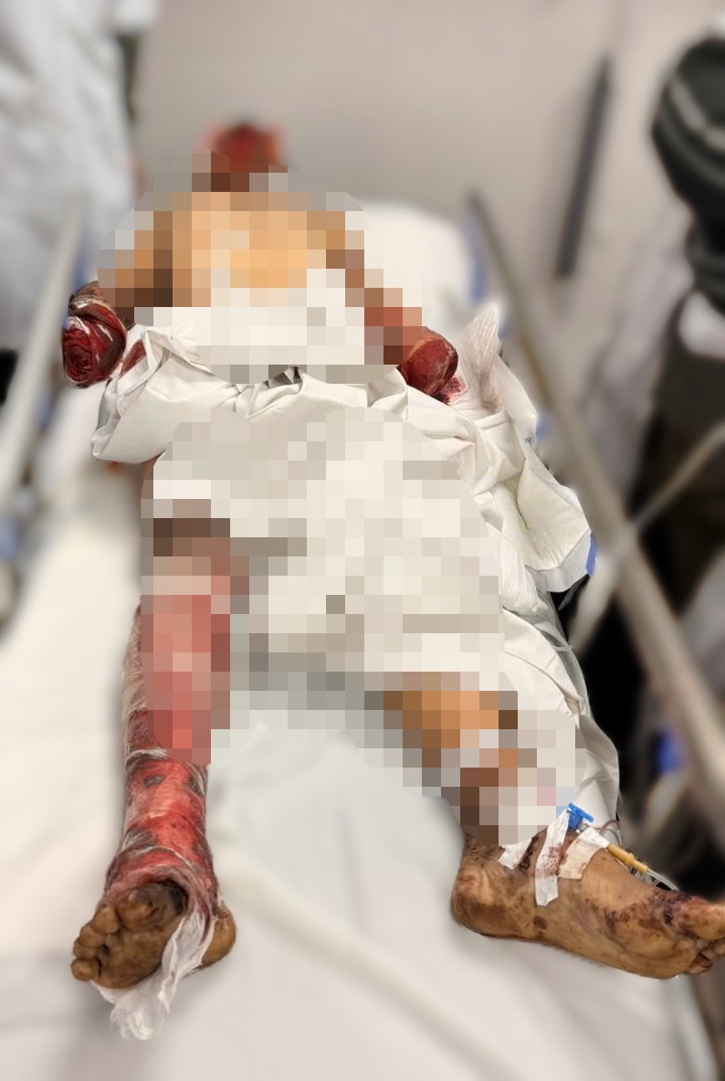 Benh nhan bi thuong nang, cut 2 chi vi phao no. Anh: BVCC