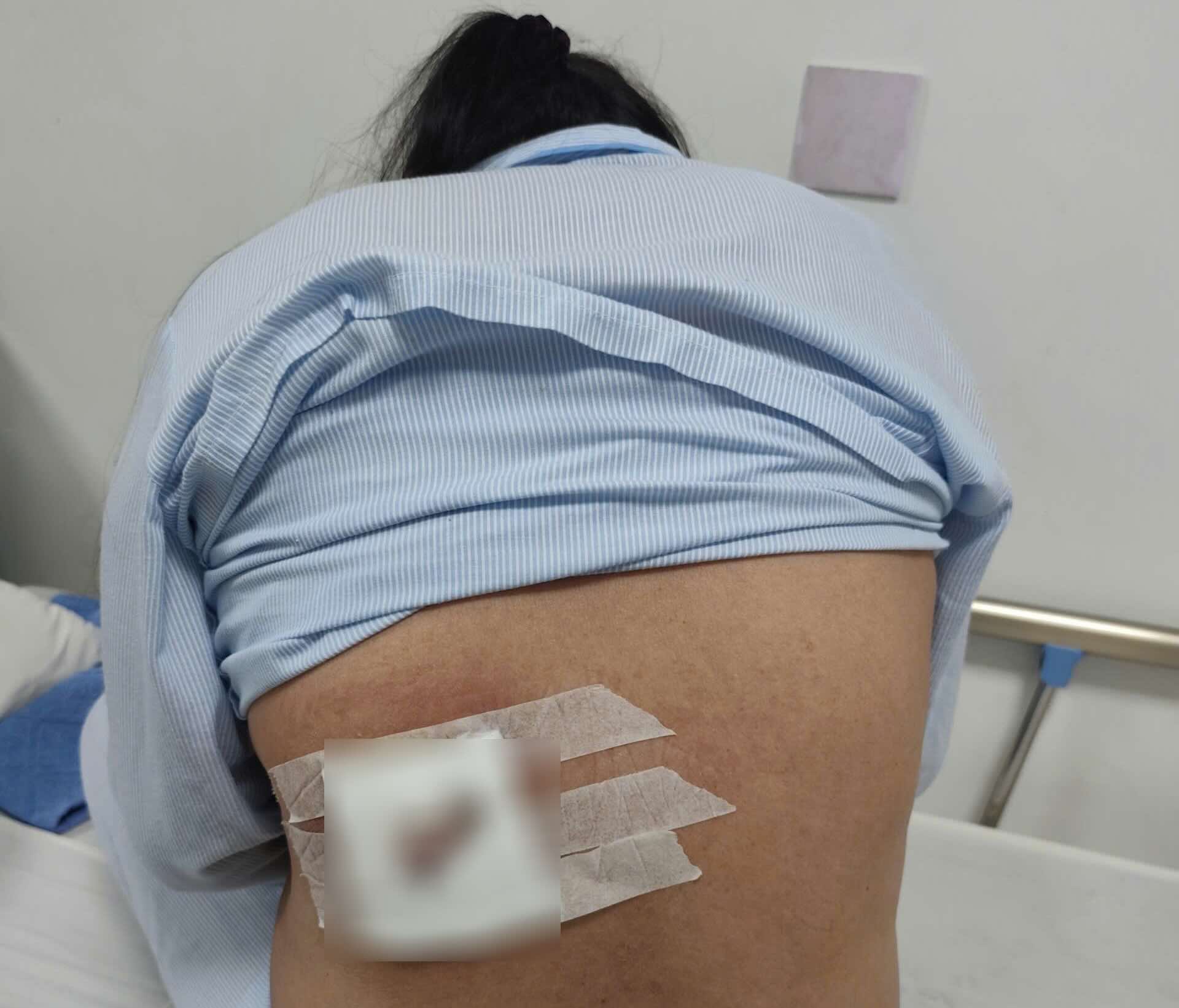 Patient with necrosis in the back due to applying leaves to treat boils, doctor warns of danger when using unproven scientific methods. Photo: Quang Binh Friendship Hospital