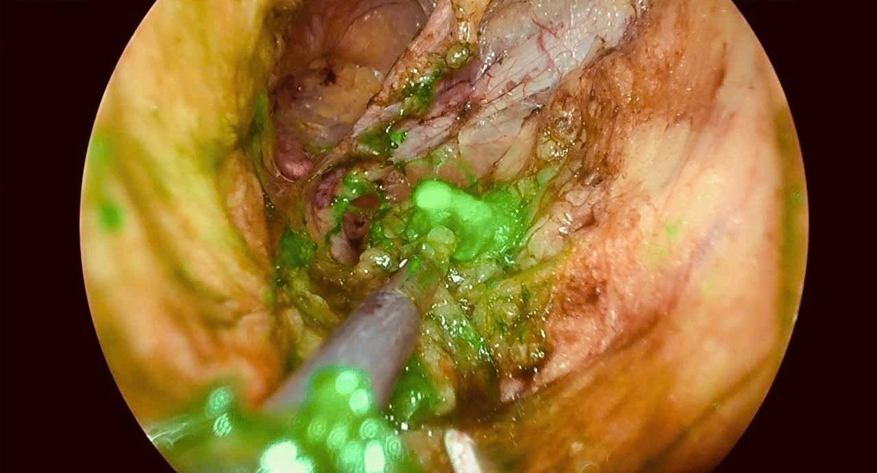 New breakthrough in the treatment of endometrial cancer. Photo: BVCC