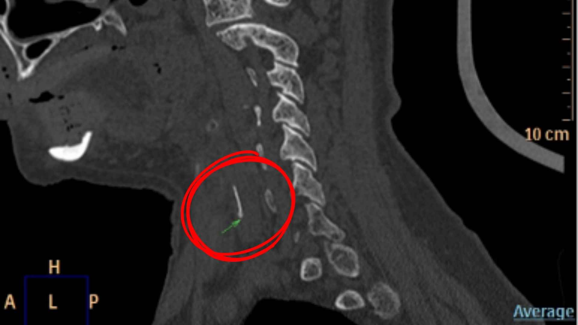 Location of fish bone ablation on X-ray. Photo: BVCC