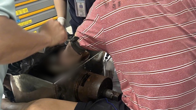 A patient suffered an occupational accident while grinding meat. Photo: BVCC