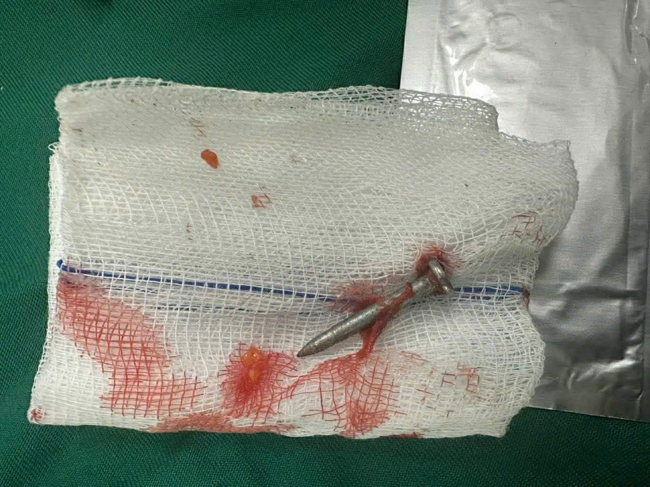 After surgery, the nail was removed. Photo: Vietnam - Cuba Friendship Hospital Dong Hoi