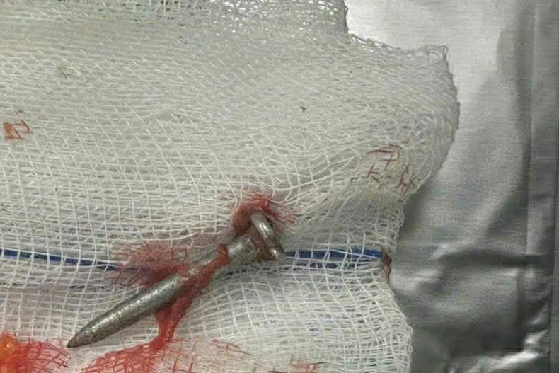 After surgery, the nail was removed. Photo: Vietnam - Cuba Friendship Hospital Dong Hoi