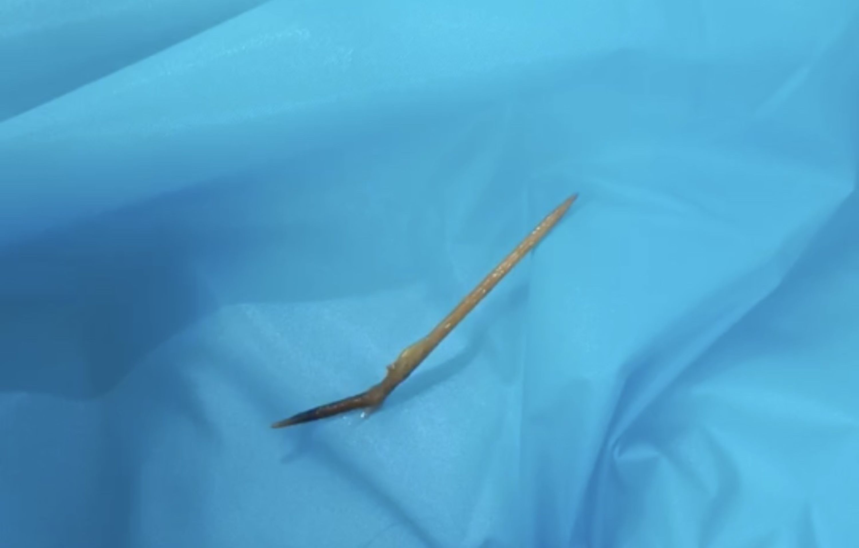 Swallowing a toothpick, a man in Khanh Hoa almost punctures his duodenum. Photo: Khanh Hoa General Hospital