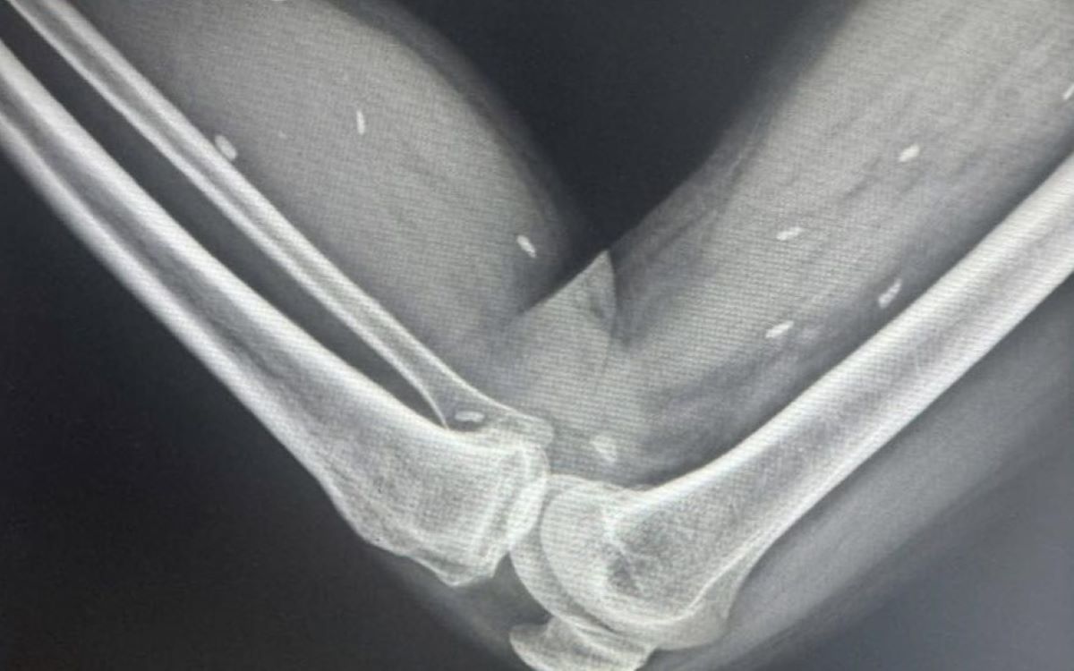 Image of many tapeworm cysts scattered in the tissues of the femur and calf. Photo: Thach Han Regional Health Center