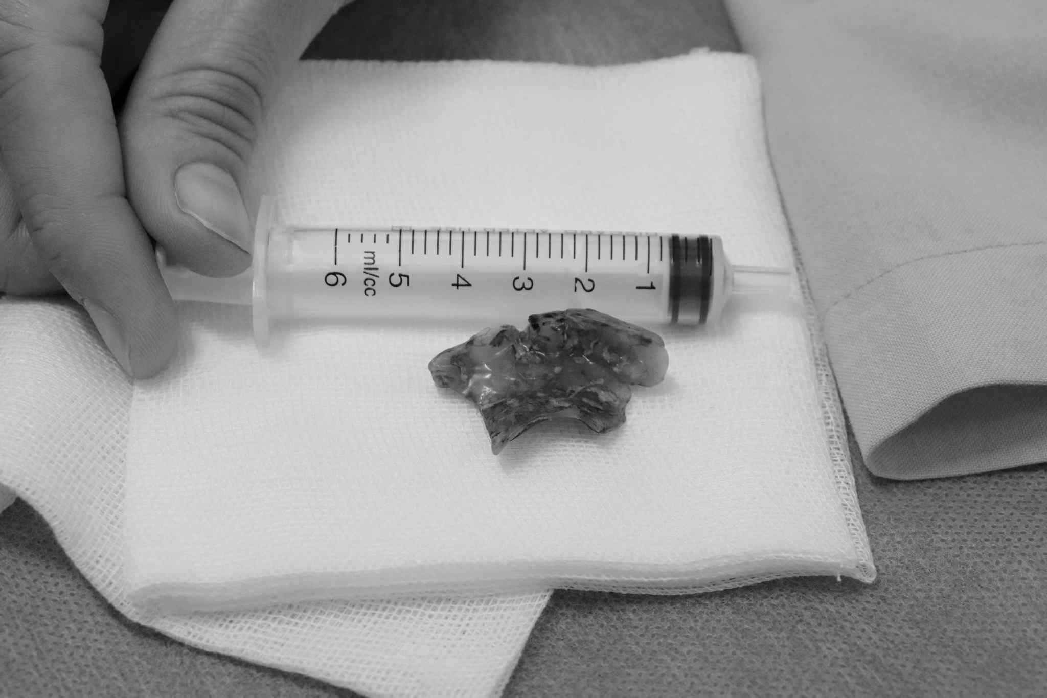 The woman had to be taken to the emergency room overnight after swallowing her dentures. Photo: Hoan My Binh Phuoc Hospital