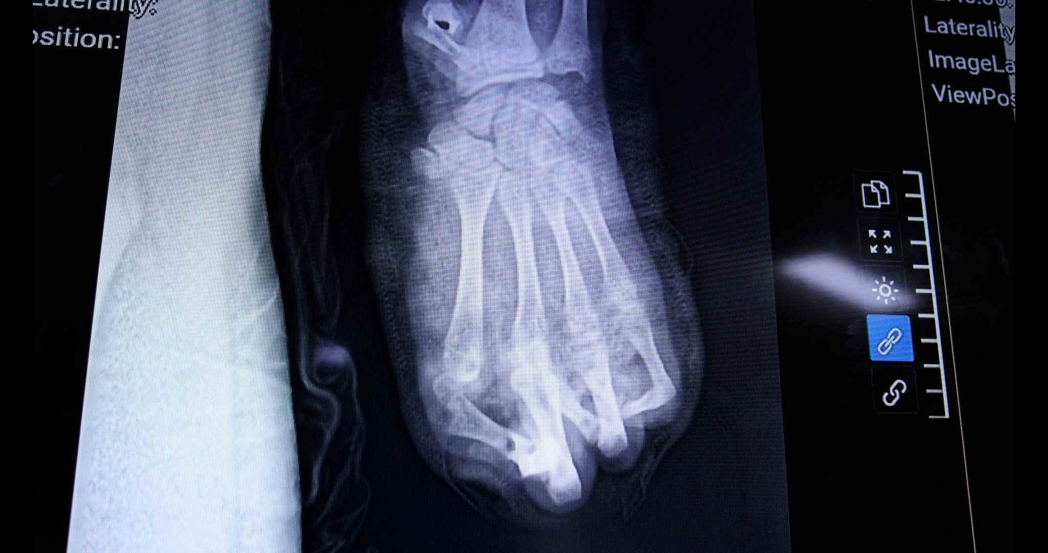 Hinh anh ban tay bi cut do phao no. Anh: BVCC