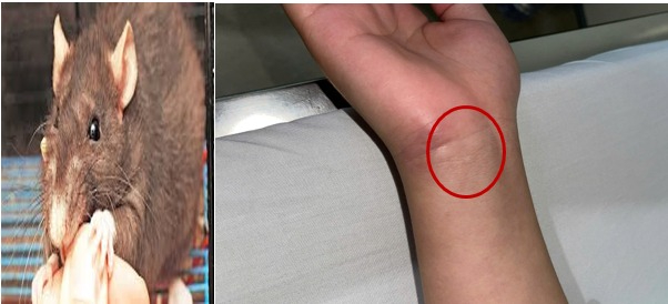 소도쿠 감염 환자의 손목에 있는 쥐 물린 자국. 사진: BVCC