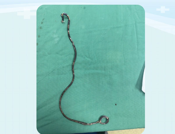 Ong thong bi bo quen trong co the benh nhan suot 10 nam. Anh: Thanh Tuan 