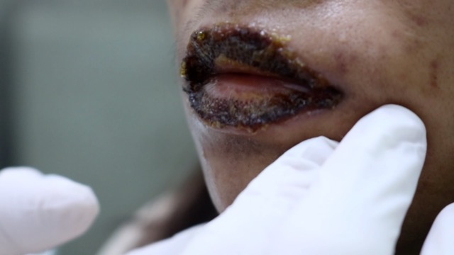 Performing cosmetic services to remove tattoos or lip tattoos without proper medical procedures will easily leave complications. Photo: BVCC