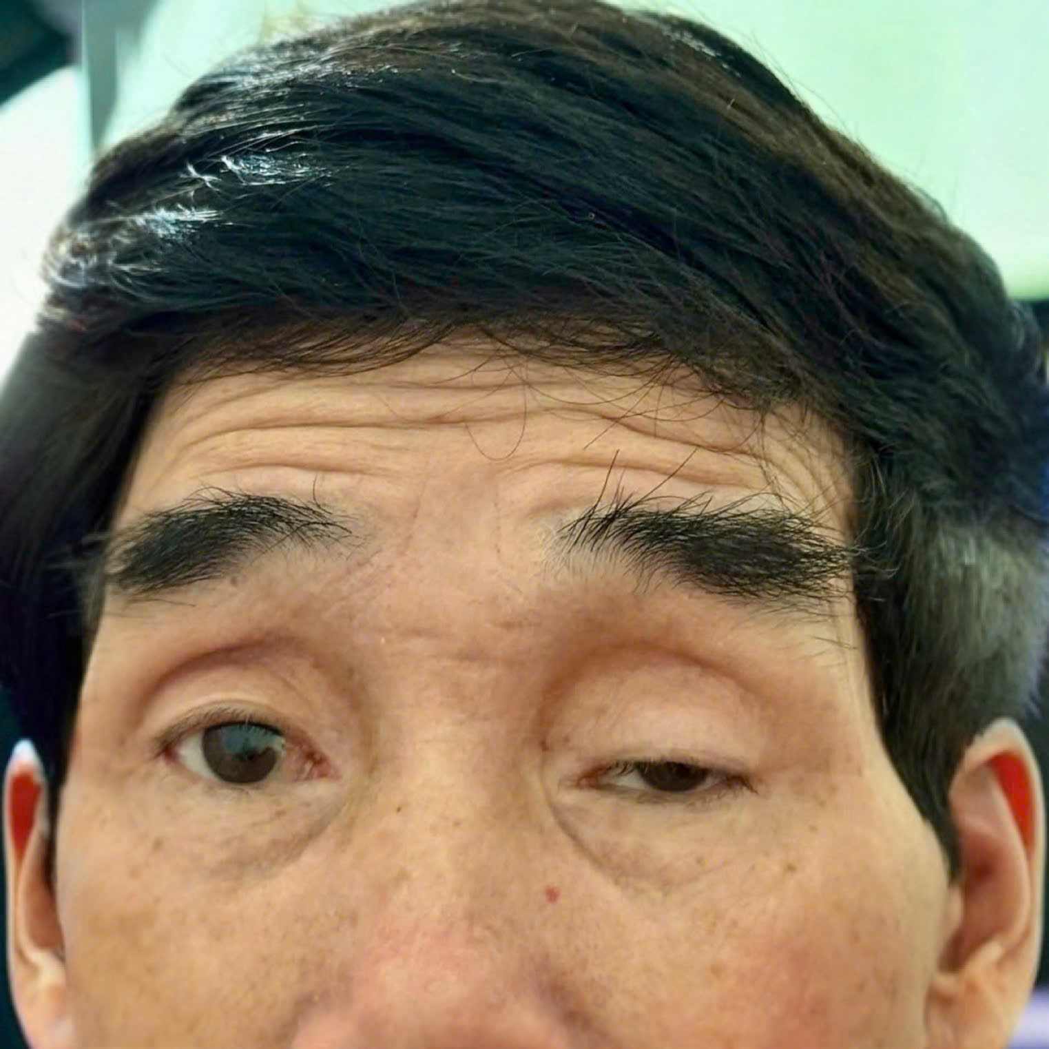 Congenital ptosis covers the pupils of patients for 65 years. Photo: Thanh Dang