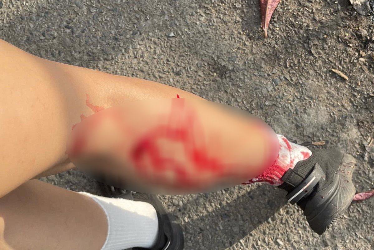 Một người bị thương do khỉ hoang tấn công vào sáng 30.1. Ảnh: NVCC