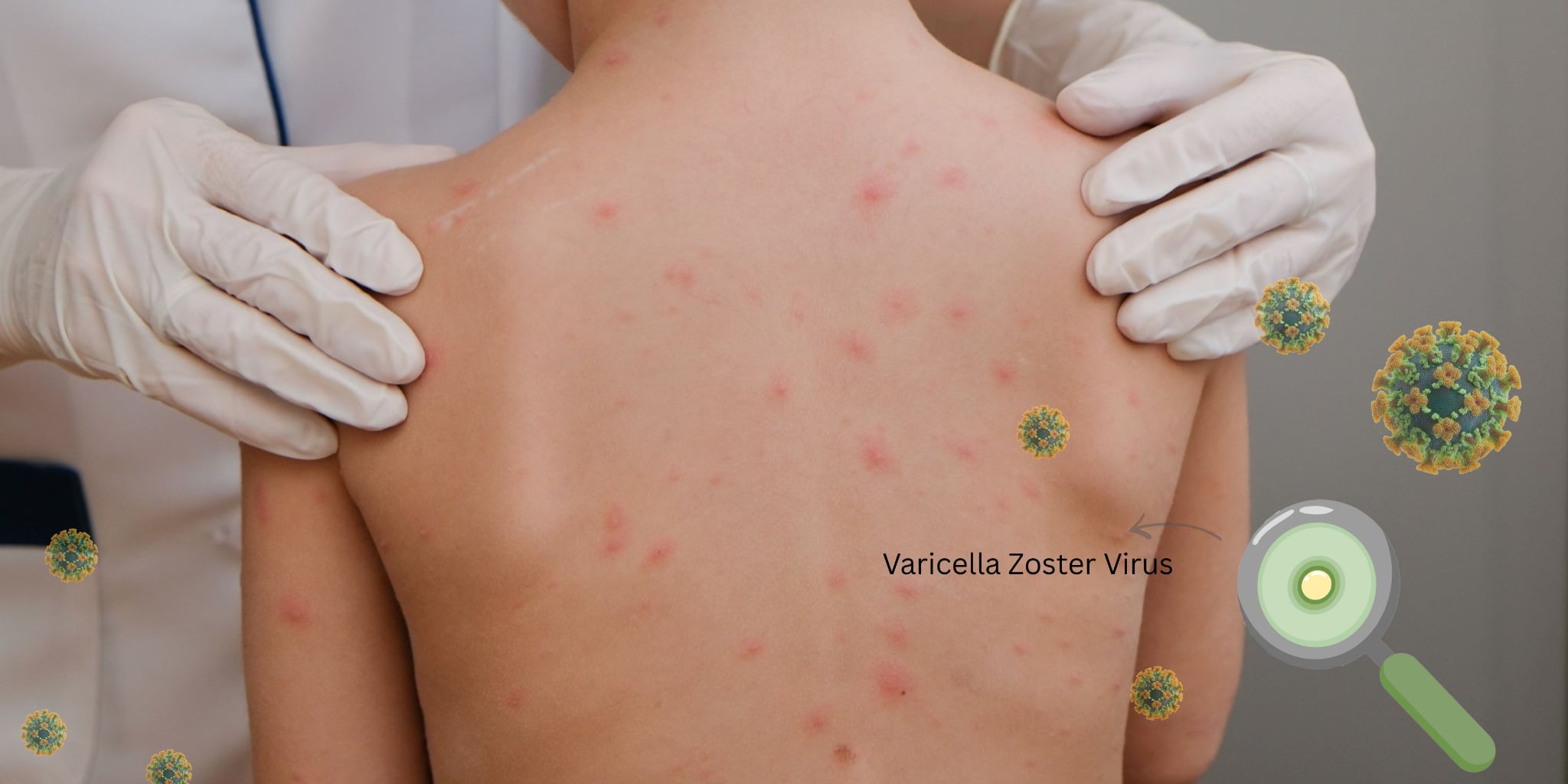 Need to get chickenpox vaccine to prevent the disease for children Photo: NAVIVA GROUP
