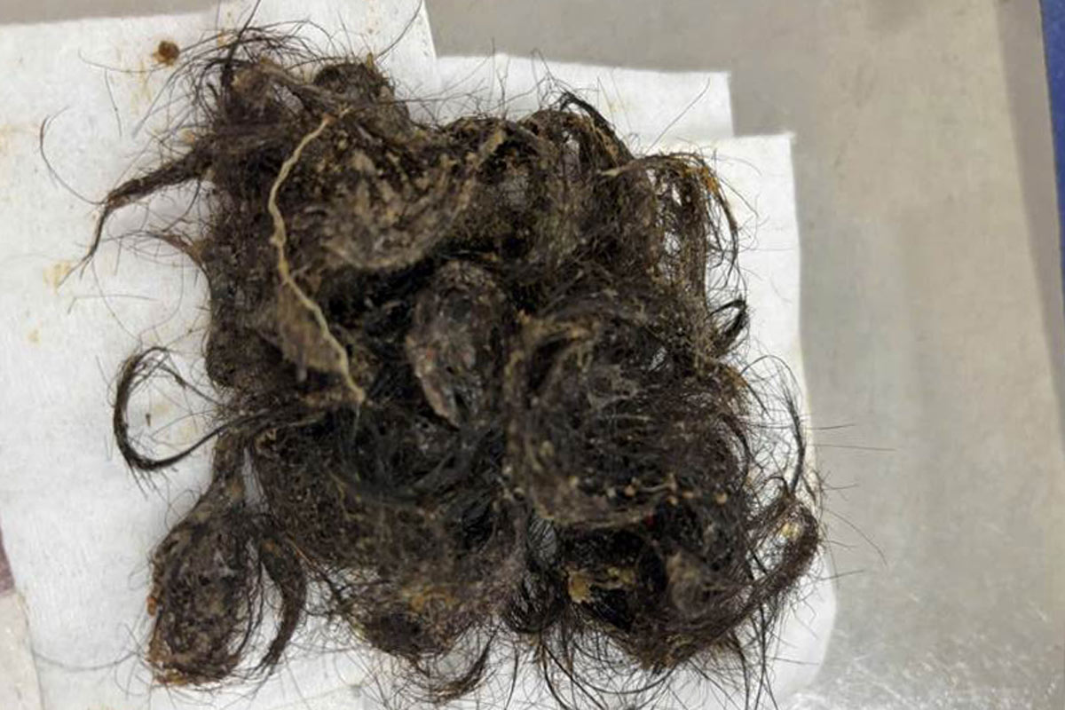 Hair bun removed from the patient's stomach. Photo: Mong Cai District General Hospital