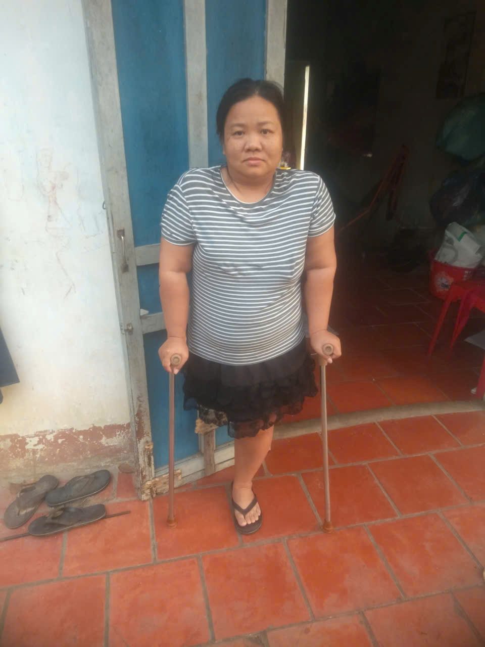 Chi Thao Vi bi ung thu xuong nen phai cat bo mot chan de giu mang song. Anh: NVCC