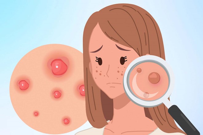 Many people after the age of 25 still experience persistent acne, recurring many times, affecting appearance and psychology. Graphics: Dinh Thien