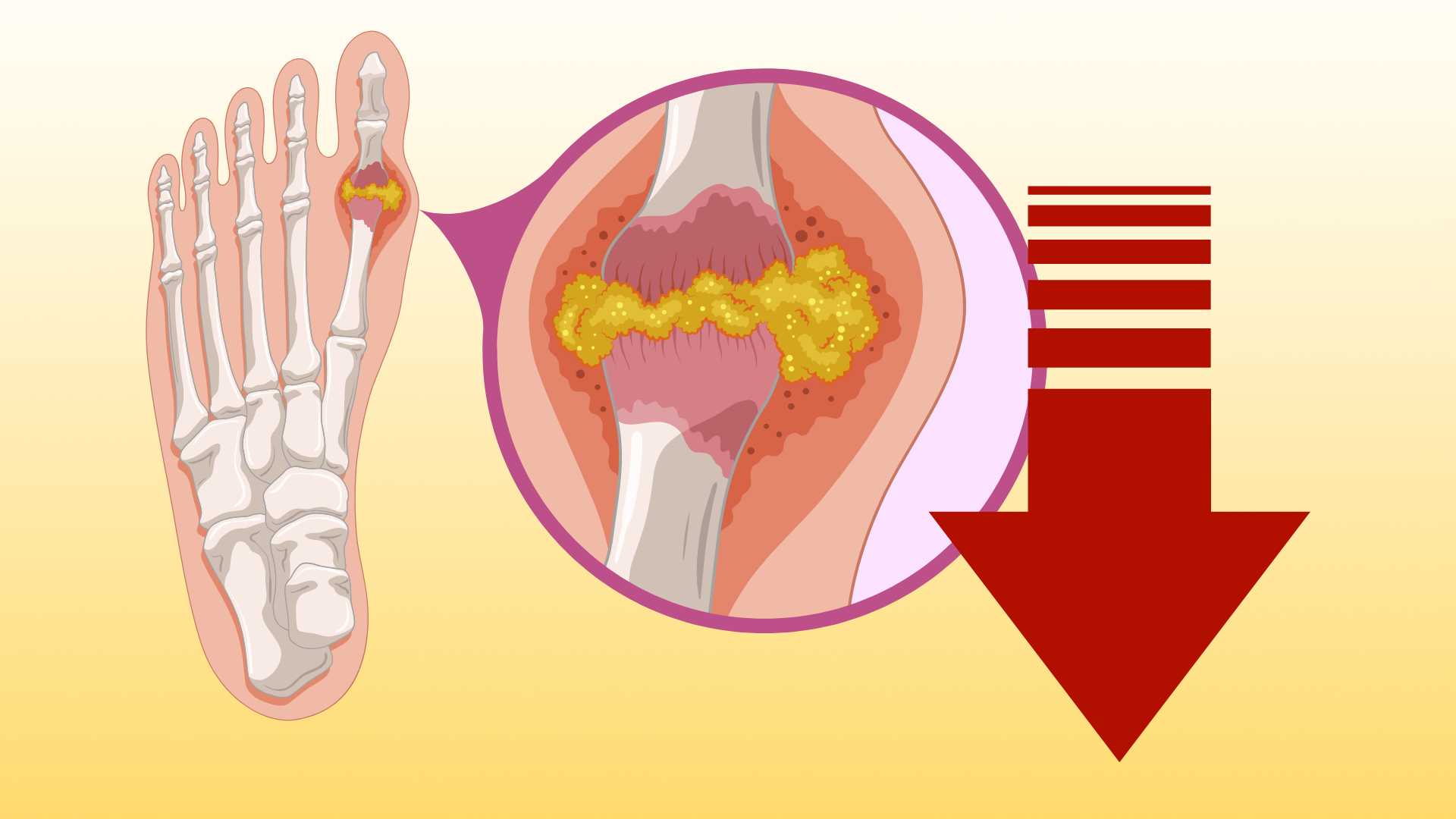 Tips to reduce natural uric acid at noon that everyone can do