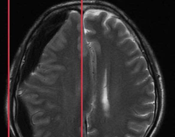 간질 발작 후 방심한 남자가 뇌출혈로 거의 사망할 뻔했습니다. 사진: BVCC