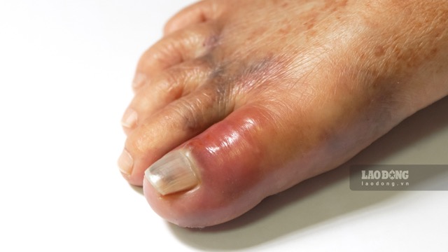 Eating a lot of meat and drinking little water can harm the kidneys and ...