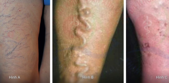 Bác sĩ cảnh báo dấu hiệu suy tĩnh mạch chi dưới