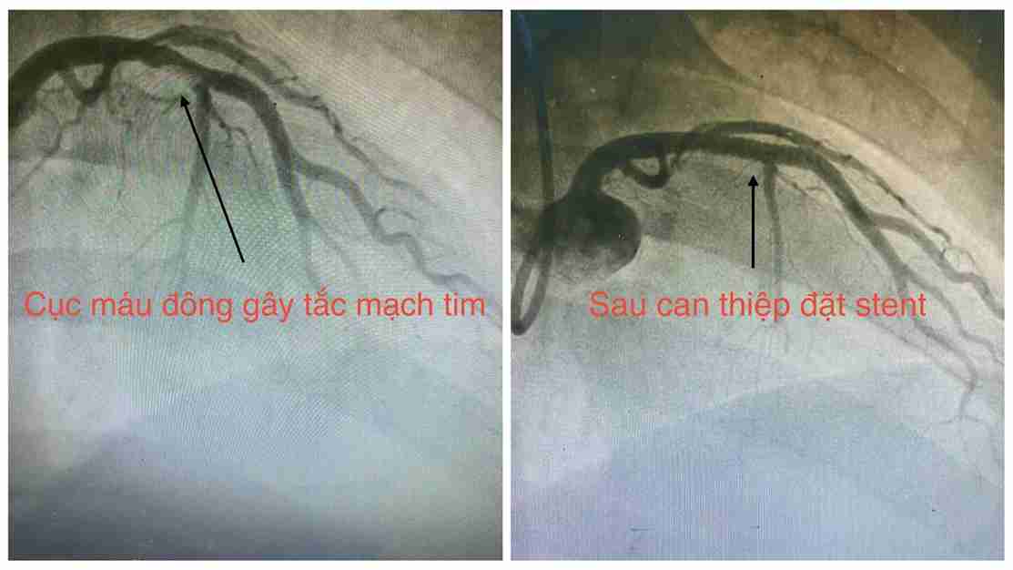 Doctors have just saved a 32-year-old man who suffered acute myocardial infarction while playing football. Photo: Hospital provided