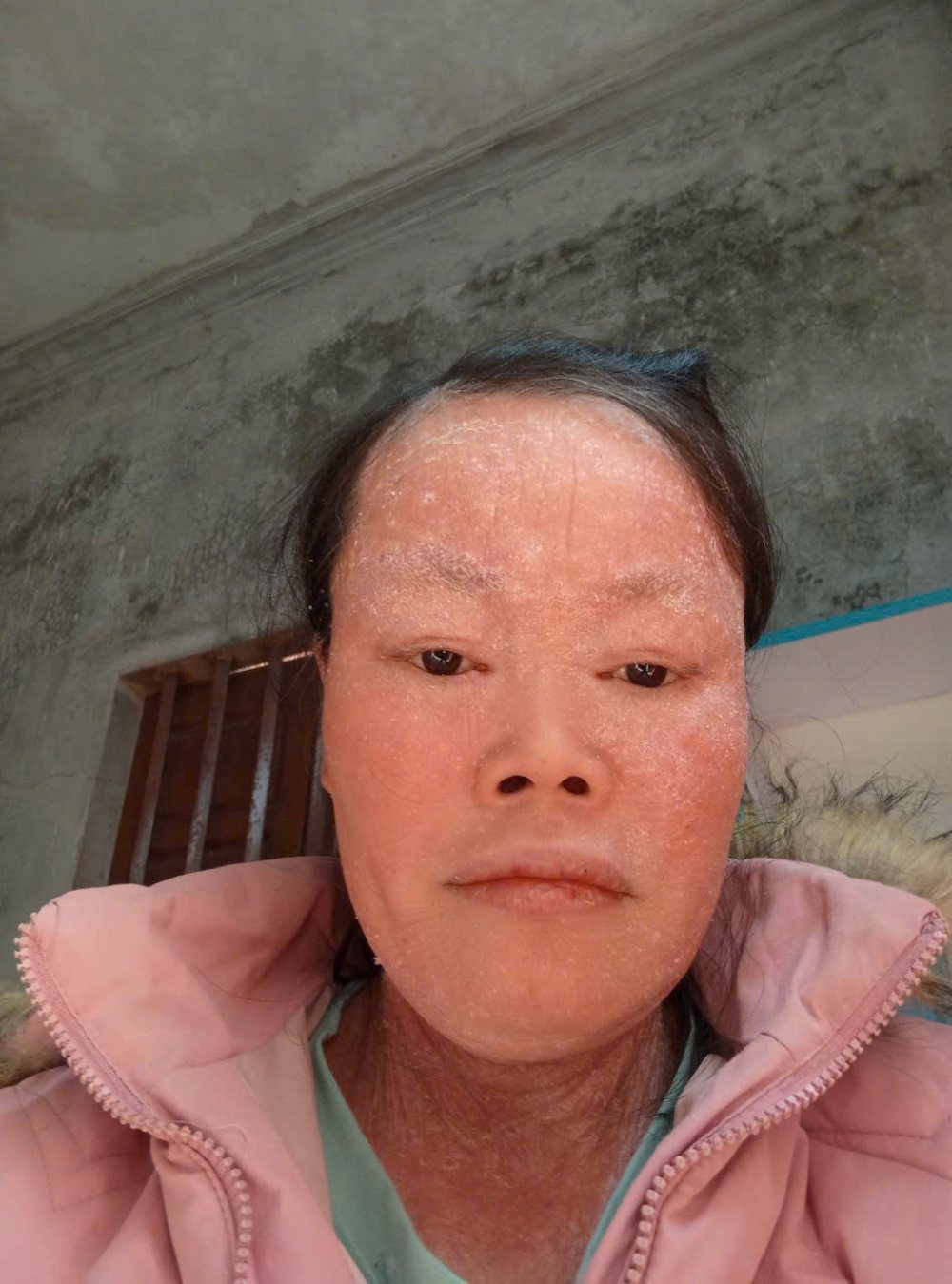 Chị Thủy - vợ anh Hưng bị mắc vảy nến bẩm sinh, sức khỏe yếu... Ảnh: Quỳnh Chi