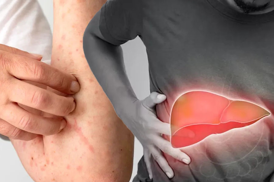 Liver problems can be warned through changes on the skin. Graphics: Thien Nhan