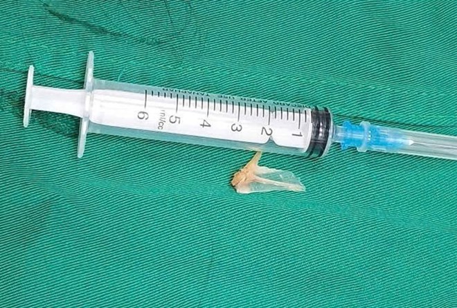 Doctors warn that children and the elderly are prone to foreign object choking during eating. Photo: Cong Sang